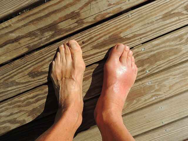 feet swelling