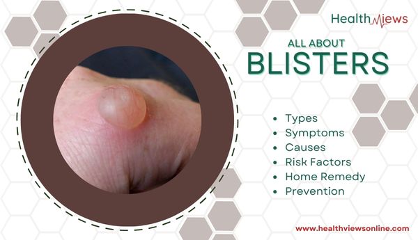 blisters