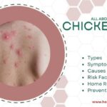 chickenpox