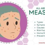 MEASLES