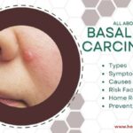 Basal cell carcinoma
