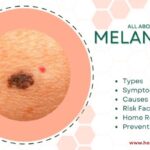 Melanoma