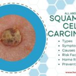 Squamous cell carcinoma