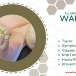 warts