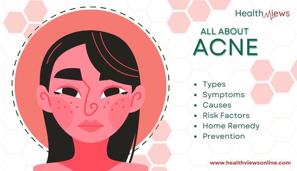all about acne