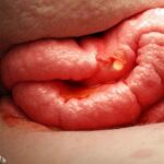 H-Pylori