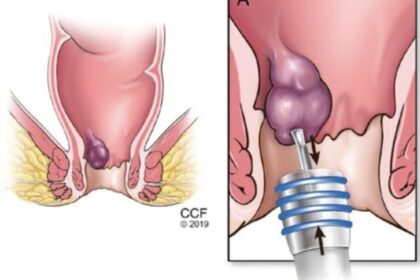 Home Remedies for hemorrhoids.