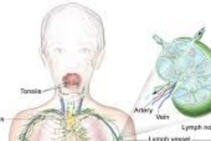 Lymphatic system diagram with affected areas highlighted.