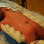 Now Know All about Birth Defect Spina Bifida