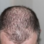 Hair Loss in Men: