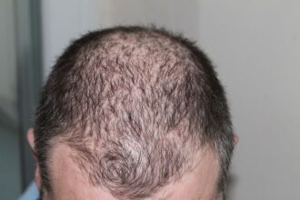 Hair Loss in Men: