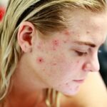 Exploring Homeopathy for Skin Conditions Like Acne and Eczema