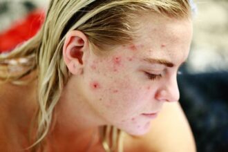 Exploring Homeopathy for Skin Conditions Like Acne and Eczema