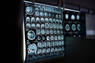 free-brain-tumor-surgery-in-india-low-cost-brain-tumor-surgery