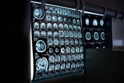 free-brain-tumor-surgery-in-india-low-cost-brain-tumor-surgery