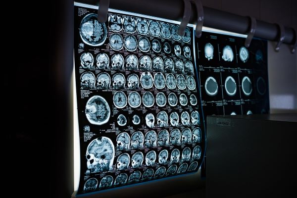 free-brain-tumor-surgery-in-india-low-cost-brain-tumor-surgery
